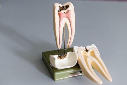 Root Canal Treatment